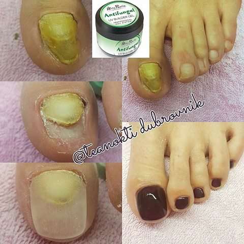 ARTY NAILS ANTIFUNGAL BUILDER GEL 15 ml - Image 3